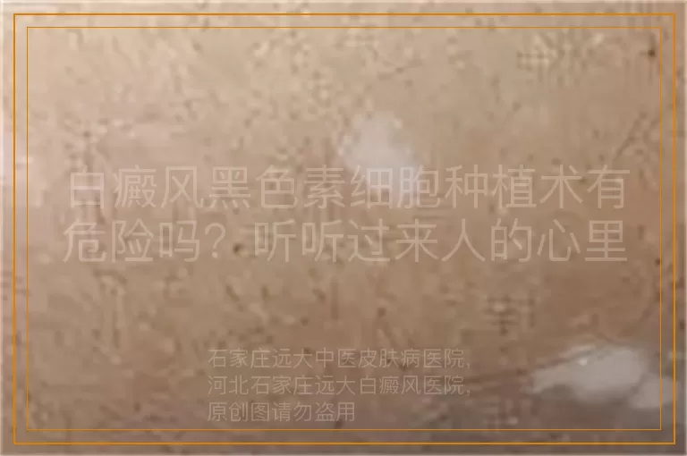 白癜风黑色素细胞种植术有危险吗？听听过来人的心里话