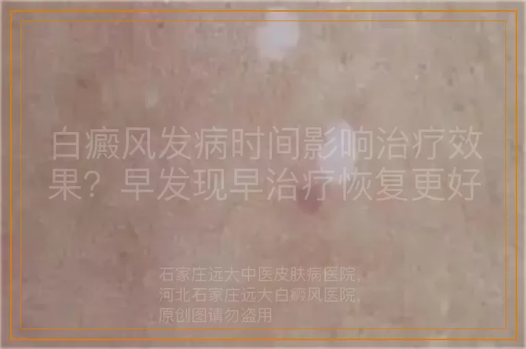 白癜风发病时间影响治疗效果？早发现早治疗恢复更好