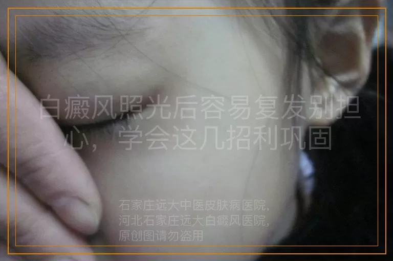 白癜风照光后容易复发别担心，学会这几招利巩固