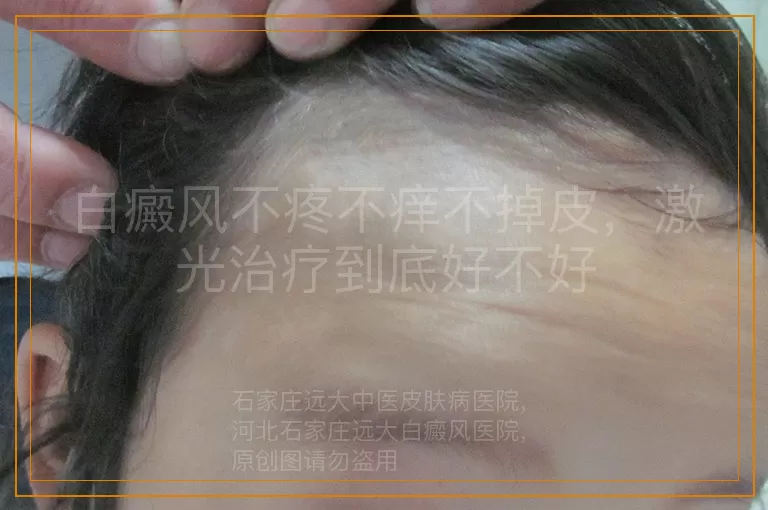 白癜风不疼不痒不掉皮，激光治疗到底好不好