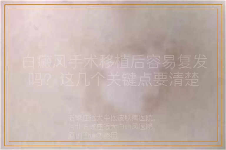 白癜风手术移植后容易复发吗？这几个关键点要清楚