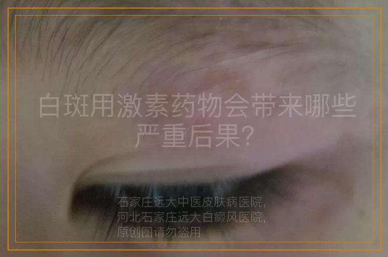 白斑用激素药物会带来哪些严重后果？