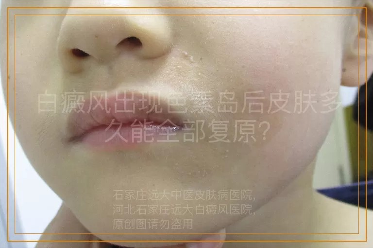 白癜风出现色素岛后皮肤多久能全部复原？