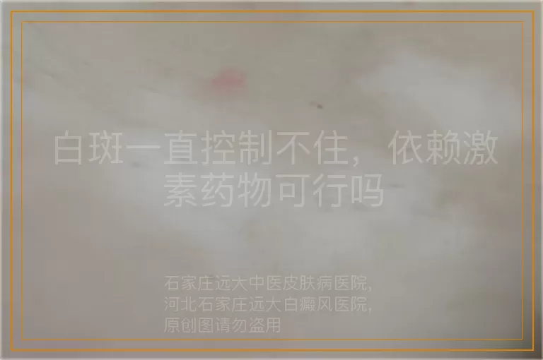 白斑一直控制不住，依赖激素药物可行吗