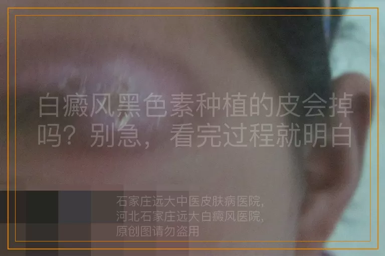 白癜风黑色素种植的皮会掉吗？别急，看完过程就明白