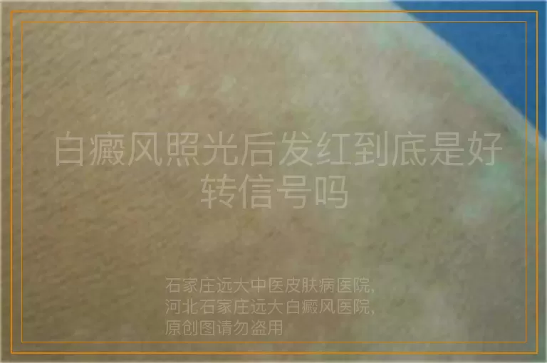 白癜风照光后发红到底是好转信号吗