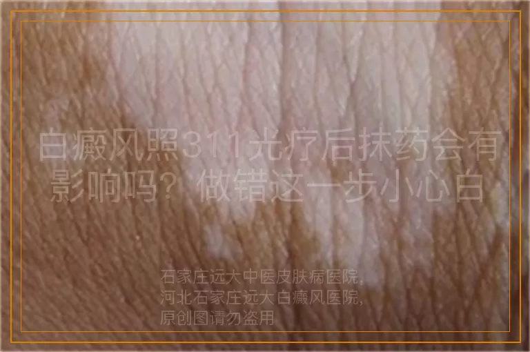 白癜风照311光疗后抹药会有影响吗？做错这一步小心白费功夫