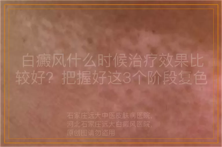 白癜风什么时候治疗效果比较好？把握好这3个阶段复色更快