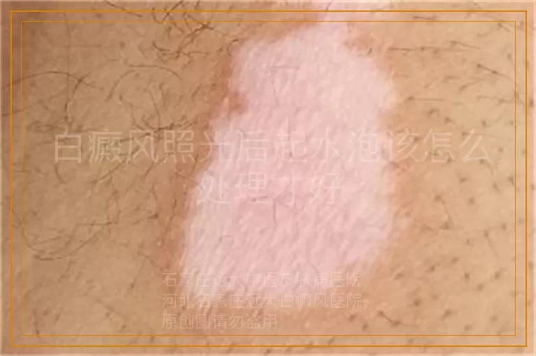 白癜风照光后起水泡该怎么处理才好
