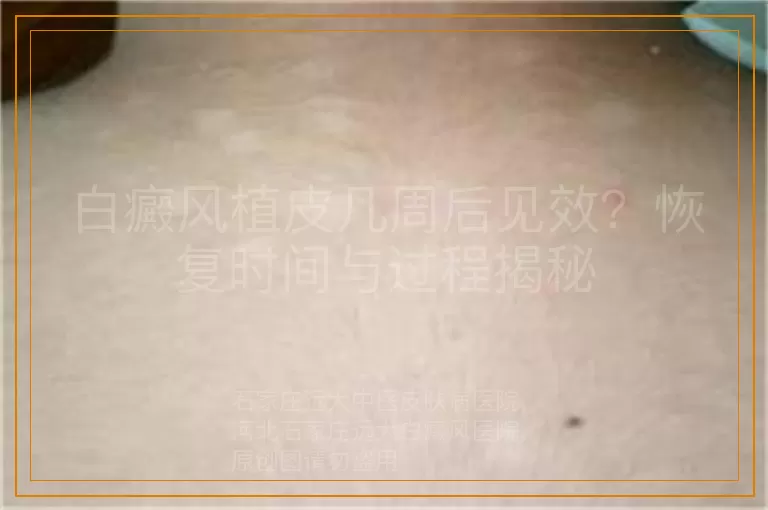 白癜风植皮几周后见效？恢复时间与过程揭秘