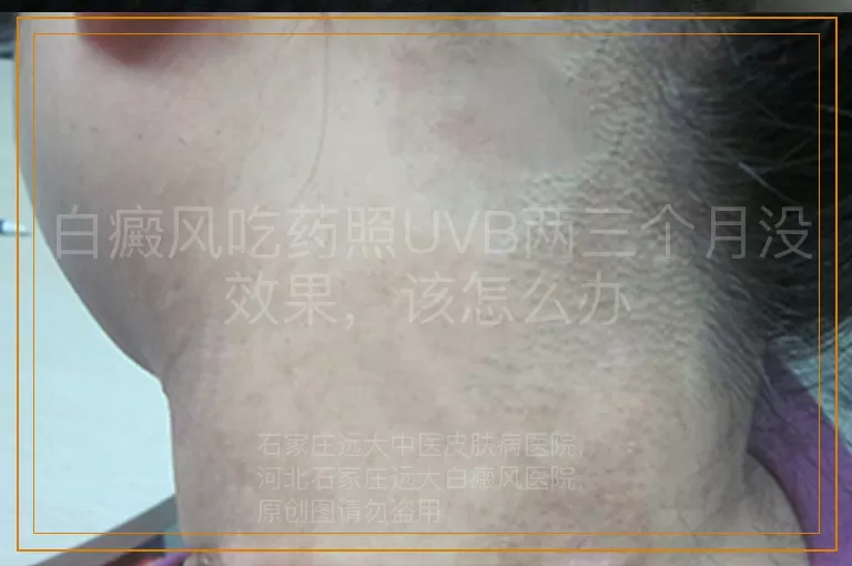白癜风吃药照UVB两三个月没效果，该怎么办