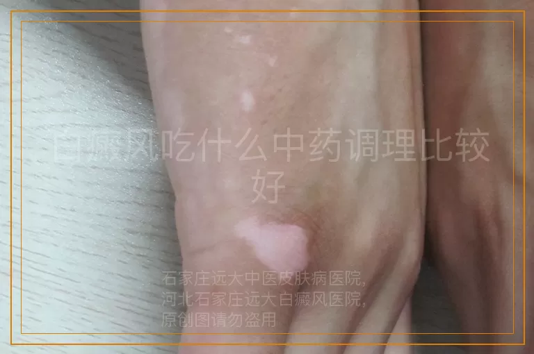 白癜风吃什么中药调理比较好