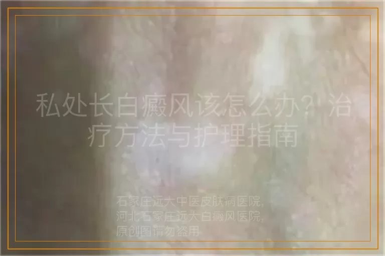 私处长白癜风该怎么办？治疗方法与护理指南