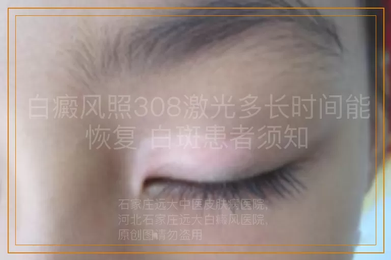 白癜风照308激光多长时间能恢复 白斑患者须知