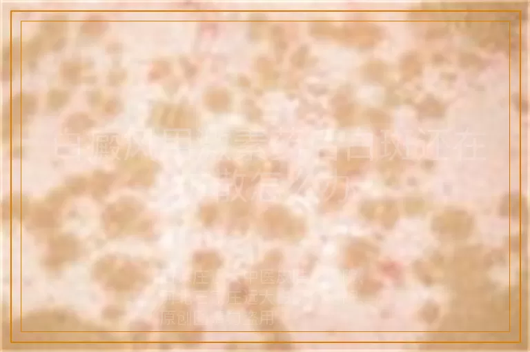 白癜风用激素药后白斑还在扩散怎么办