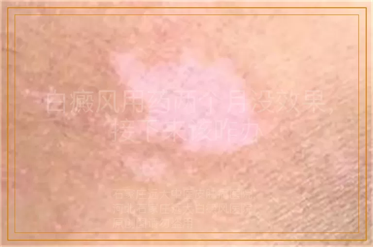白癜风用药两个月没效果，接下来该咋办