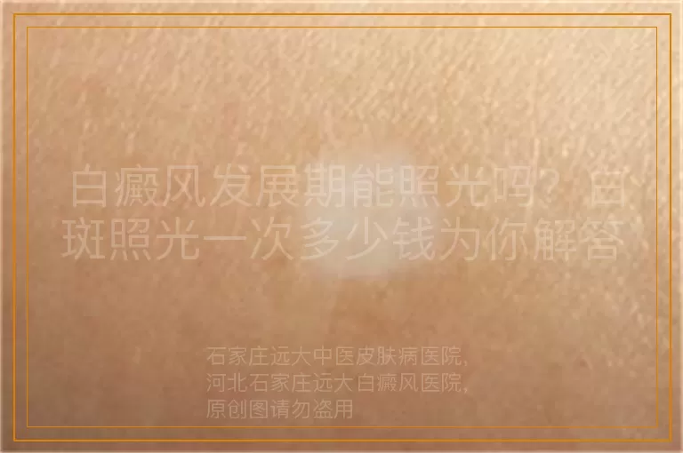 白癜风发展期能照光吗？白斑照光一次多少钱为你解答