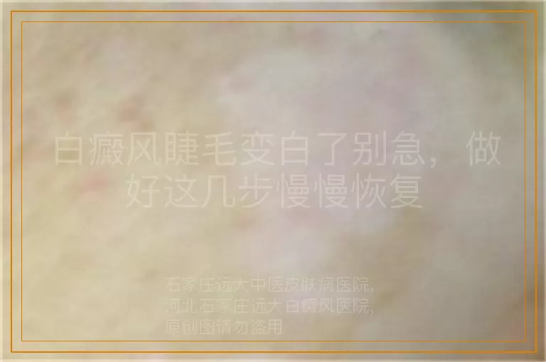 白癜风睫毛变白了别急，做好这几步慢慢恢复