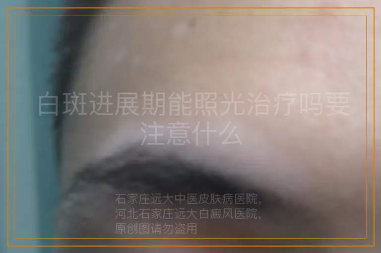 白斑进展期能照光治疗吗要注意什么