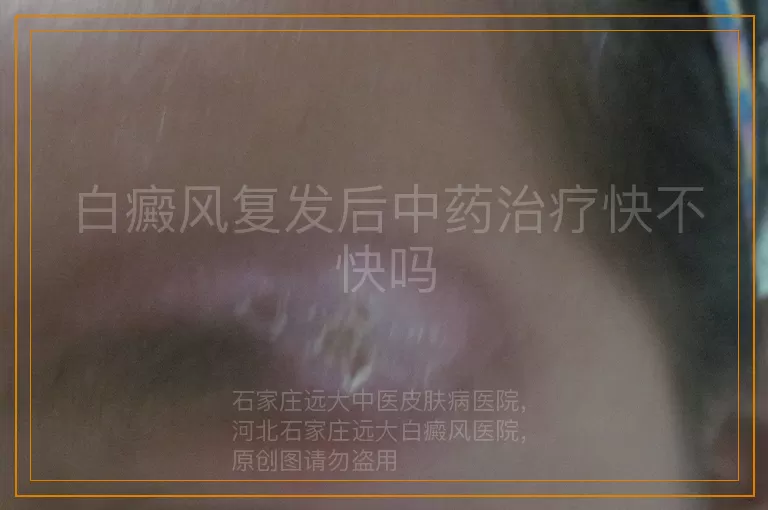 白癜风复发后中药治疗快不快吗