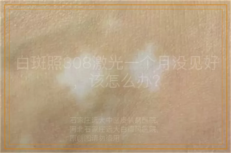 白斑照308激光一个月没见好，该怎么办？