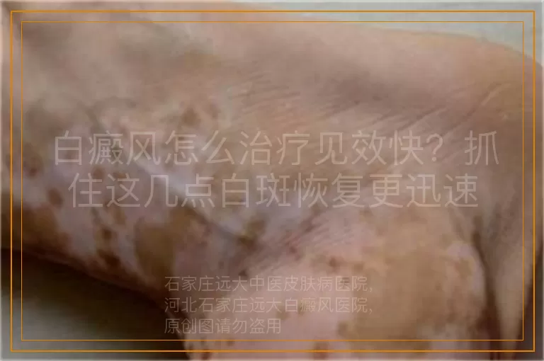 白癜风怎么治疗见效快？抓住这几点白斑恢复更迅速