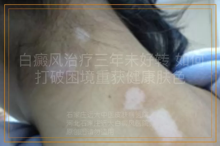 白癜风治疗三年未好转 如何打破困境重获健康肤色