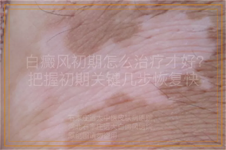 白癜风初期怎么治疗才好？把握初期关键几步恢复快