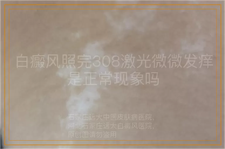 白癜风照完308激光微微发痒是正常现象吗