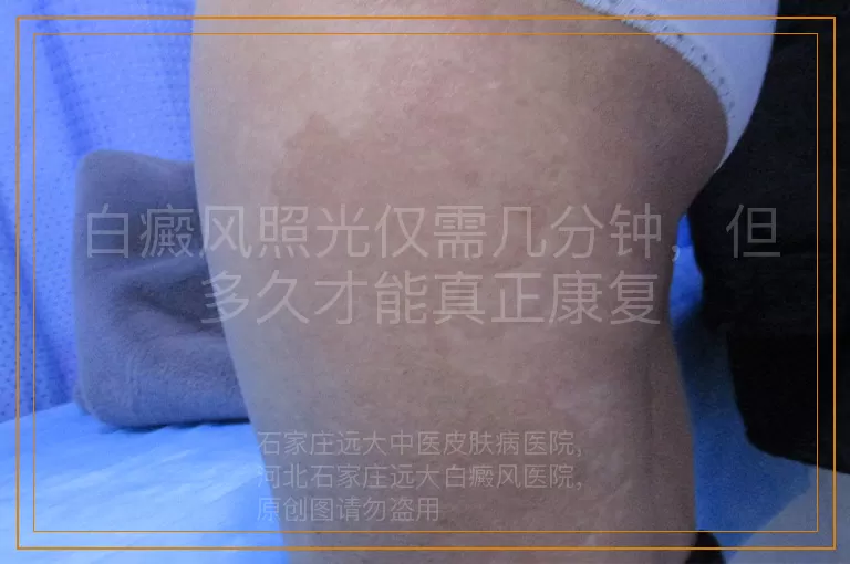 白癜风照光仅需几分钟，但多久才能真正康复