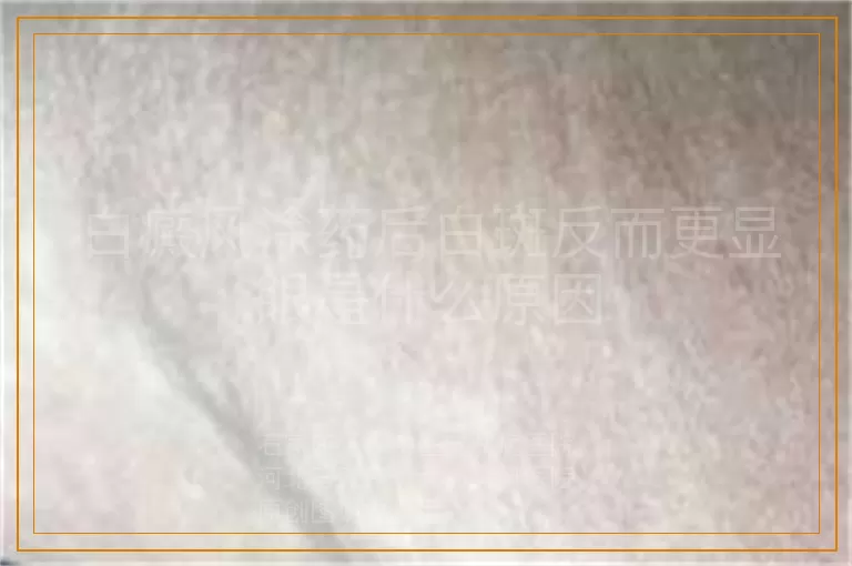 白癜风涂药后白斑反而更显眼是什么原因