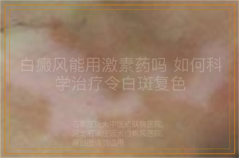 白癜风能用激素药吗 如何科学治疗令白斑复色
