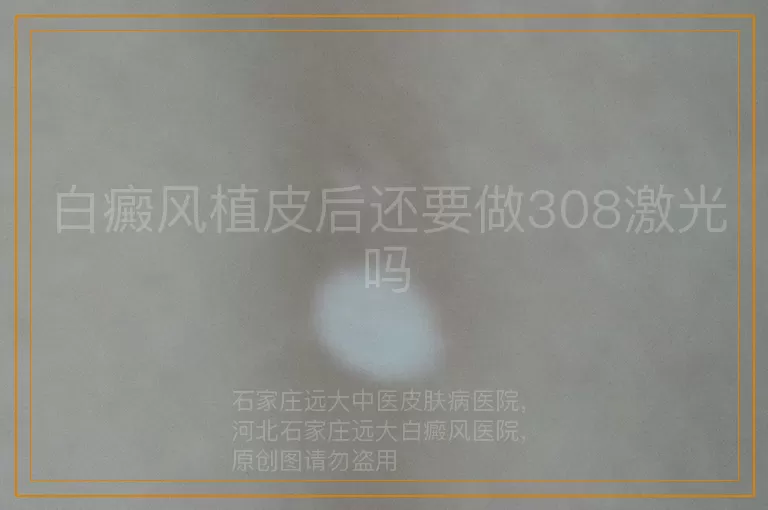 白癜风植皮后还要做308激光吗
