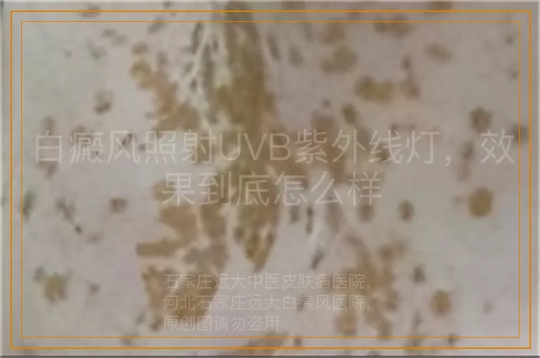 白癜风照射UVB紫外线灯，效果到底怎么样