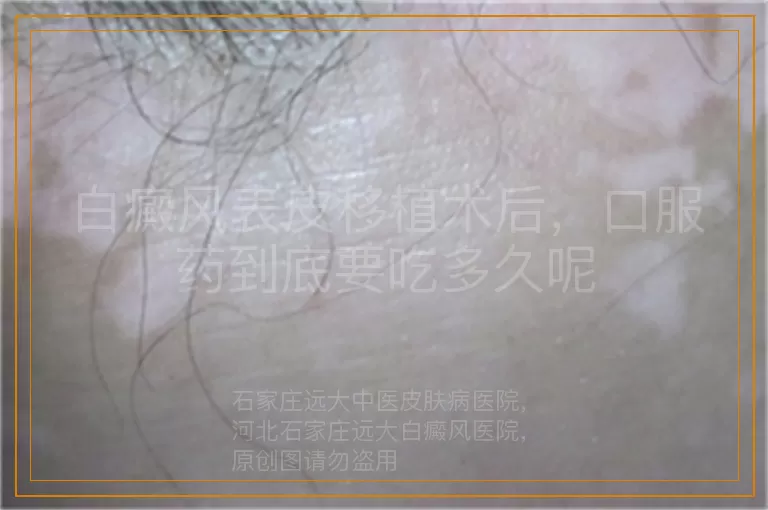 白癜风表皮移植术后，口服药到底要吃多久呢