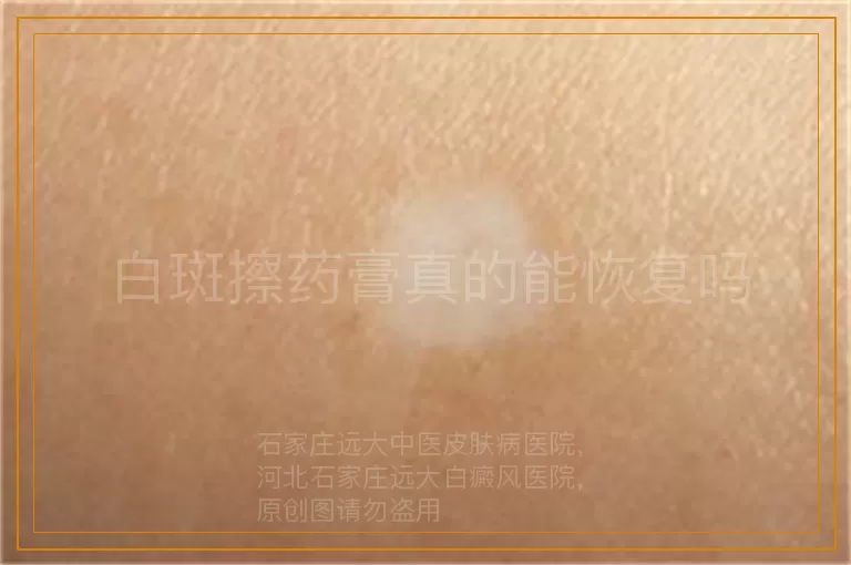白斑擦药膏真的能恢复吗