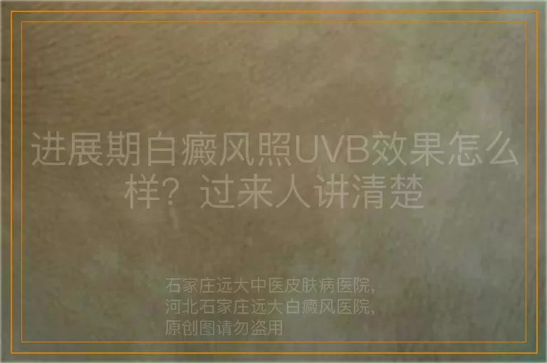 进展期白癜风照UVB效果怎么样？过来人讲清楚