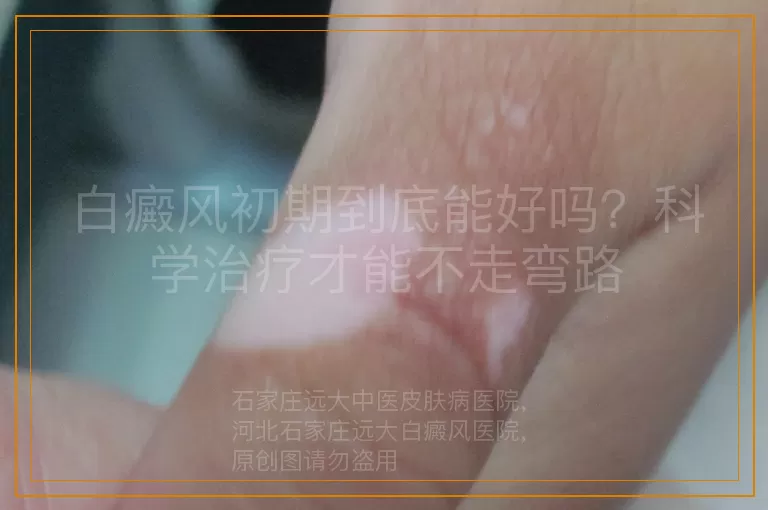 白癜风初期到底能好吗？科学治疗才能不走弯路