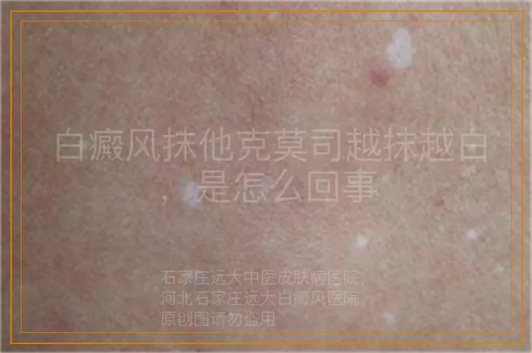 白癜风抹他克莫司越抹越白，是怎么回事