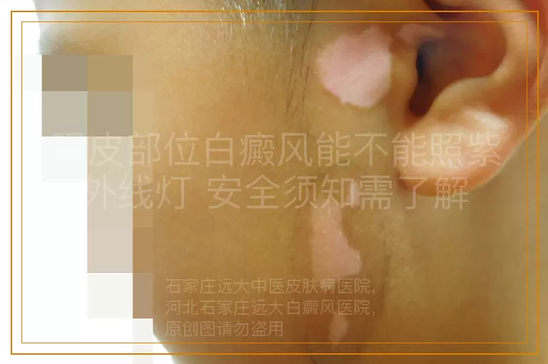 眼皮部位白癜风能不能照紫外线灯 安全须知需了解