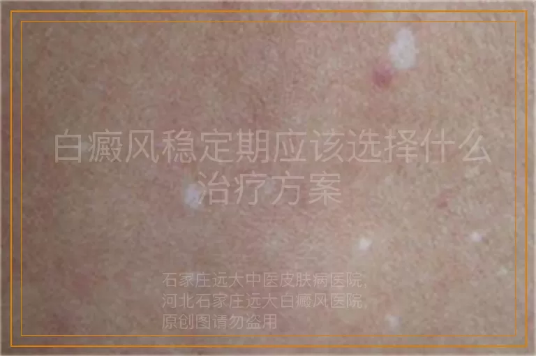 白癜风稳定期应该选择什么治疗方案