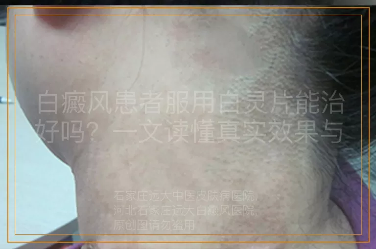 白癜风患者服用白灵片能治好吗？一文读懂真实效果与正确应对方法