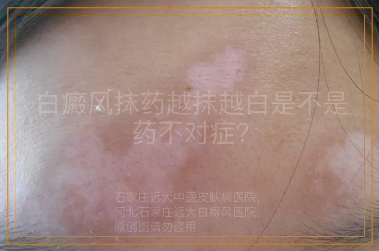 白癜风抹药越抹越白是不是药不对症？