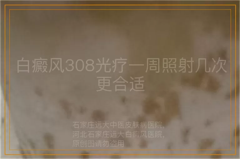 白癜风308光疗一周照射几次更合适