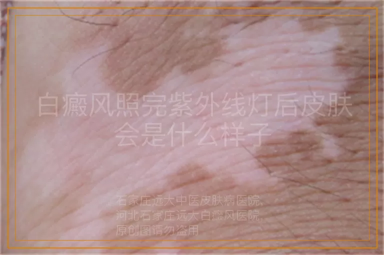 白癜风照完紫外线灯后皮肤会是什么样子