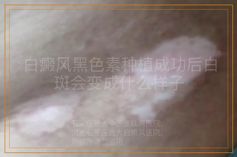 白癜风黑色素种植成功后白斑会变成什么样子