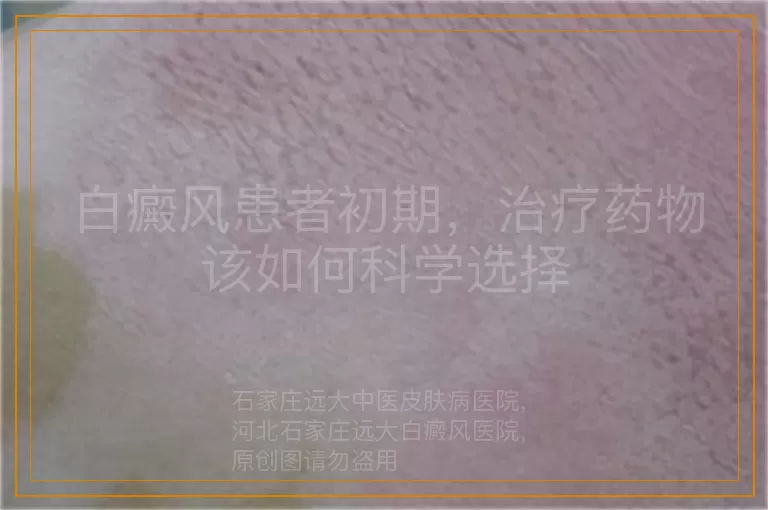 白癜风患者初期，治疗药物该如何科学选择
