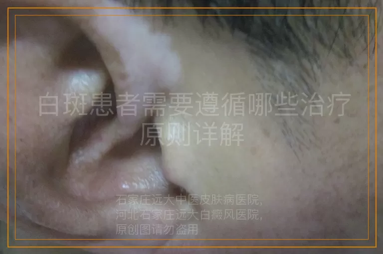 白斑患者需要遵循哪些治疗原则详解