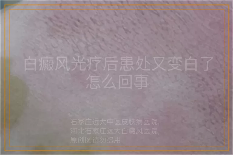 白癜风光疗后患处又变白了怎么回事