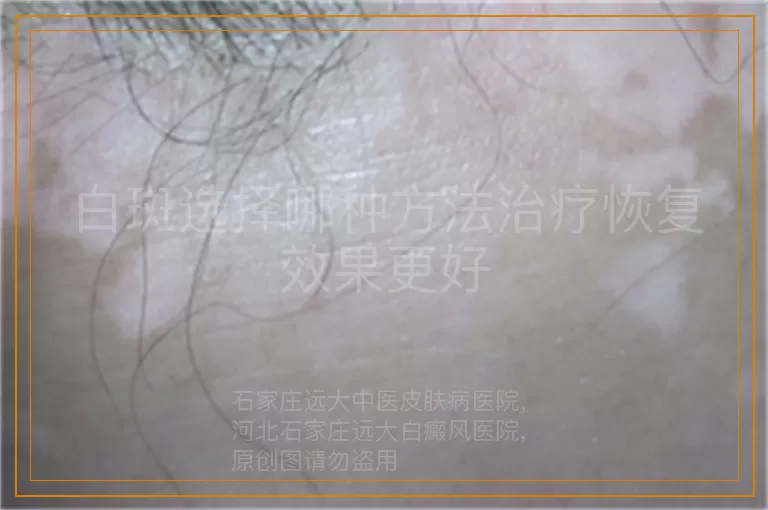 白斑选择哪种方法治疗恢复效果更好